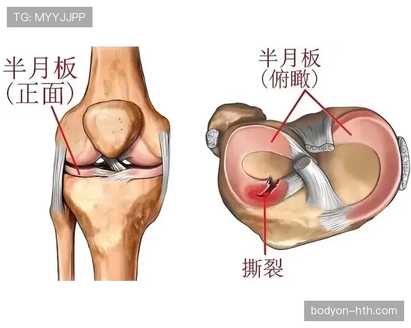 加维半月板损伤详情 加维半月板损伤详情